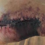 L-Incroyable Blessure de Santi Cazorla- Une Histoire de Résilience