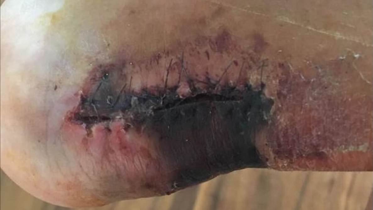 L-Incroyable Blessure de Santi Cazorla- Une Histoire de Résilience