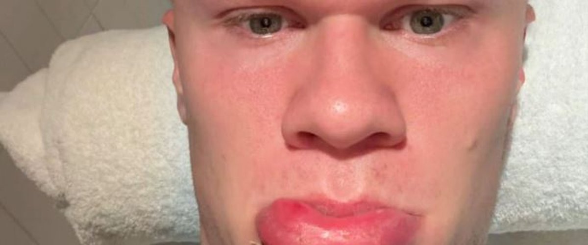 Erling Haaland blessé par une porte de bus : incident insolite en Norvège